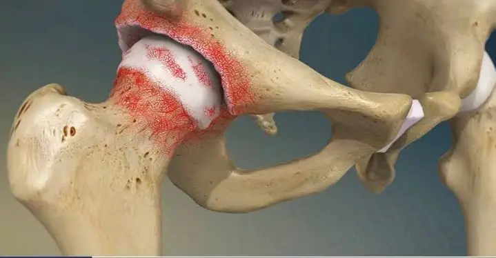 Tenho artrose no quadril. Isso pode agravar a minha dor lombar