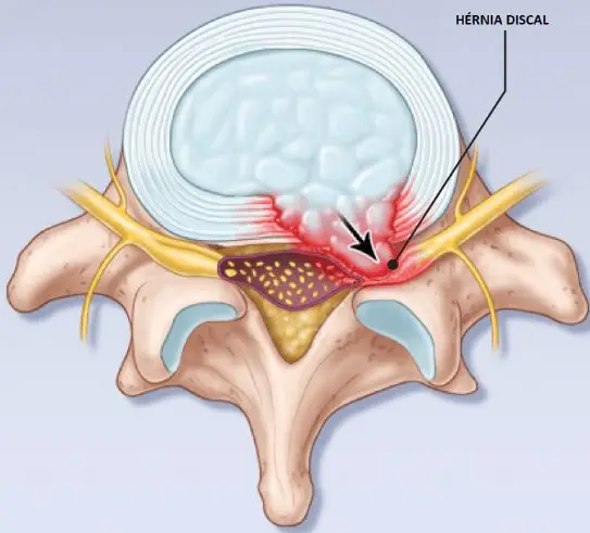 Tenho hérnia de disco na lombar Quais são as atividades que posso fazer